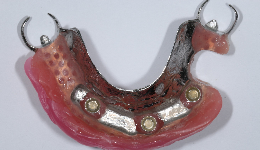 Upper teeth Securely Snap-On to the Bar Locators	